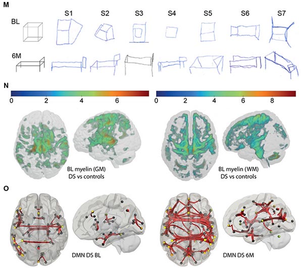 Pulsatile GnRH improves patient brain connectivity, cognition