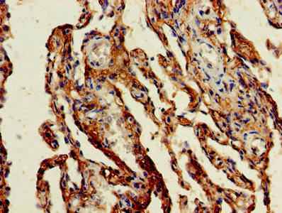 Immunohistochemistry of paraffin-embedded human lung cancer using CSB-PA009164HA01HU at dilution of 1:100