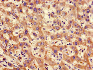 Immunohistochemistry of paraffin-embedded human liver cancer using CSB-PA018559LA01HU at dilution of 1:100