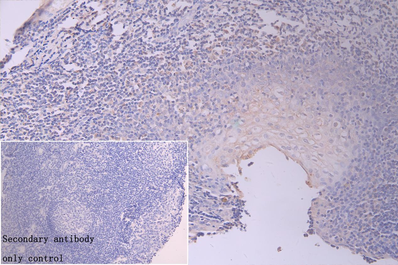 Immunohistochemistry of paraffin-embedded human gastric cancer using CSB-PA846610LA01HU at dilution of 1:100