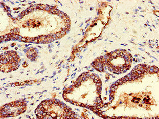 Immunohistochemistry of paraffin-embedded human prostate cancer using CSB-PA863993LA01HU at dilution of 1:100