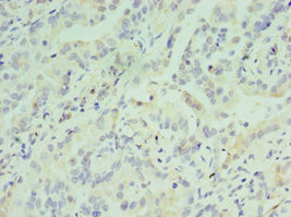 Immunohistochemistry of paraffin-embedded human lung cancer using CSB-PA002279ESR2HU at dilution of 1:100