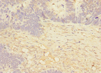 Immunohistochemistry of paraffin-embedded human ovarian cancer using CSB-PA013440DSR1HU at dilution of 1:100