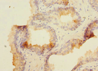 Immunohistochemistry of paraffin-embedded human prostate cancer using CSB-PA013440DSR1HU at dilution of 1:100