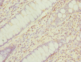 Immunohistochemistry of paraffin-embedded human colon cancer using CSB-PA018489DSR1HU at dilution of 1:100