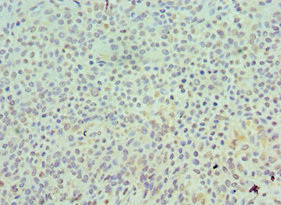 Immunohistochemistry of paraffin-embedded human breast cancer using CSB-PA021360ESR1HU at dilution of 1:100