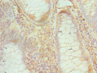 Immunohistochemistry of paraffin-embedded human colon cancer using CSB-PA614436ESR2HU at dilution of 1:100