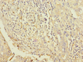 Immunohistochemistry of paraffin-embedded human lung cancer using CSB-PA614805ESR1HU at dilution of 1:100