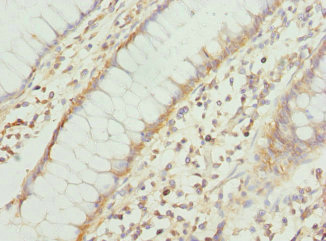 Immunohistochemistry of paraffin-embedded human colon cancer using CSB-PA621520ESR1HU at dilution of 1:100