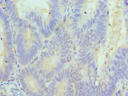 Immunohistochemistry of paraffin-embedded human colon cancer using CSB-PA835890ESR2HU at dilution of 1:100