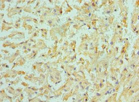 Immunohistochemistry of paraffin-embedded human liver cancer using CSB-PA850383ESR1HU at dilution of 1:100