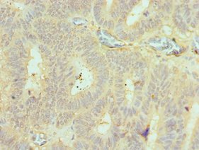 Immunohistochemistry of paraffin-embedded human colon cancer using CSB-PA850383ESR2HU at dilution of 1:100