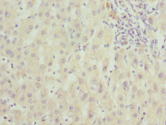 Immunohistochemistry of paraffin-embedded human liver cancer using CSB-PA850394ESR2HU at dilution of 1:100