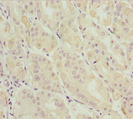 Immunohistochemistry of paraffin-embedded human gastric cancer using CSB-PA853416ESR1HU at dilution of 1:100