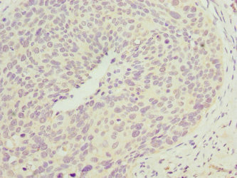 Immunohistochemistry of paraffin-embedded human cervical cancer using CSB-PA866275ESR2HU at dilution of 1:100