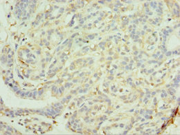 Immunohistochemistry of paraffin-embedded human breast cancer using CSB-PA887003DSR2HU at dilution of 1:100