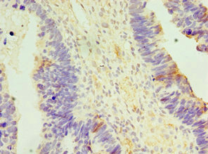 Immunohistochemistry of paraffin-embedded human ovarian cancer using CSB-PA889097ESR2HU at dilution of 1:100