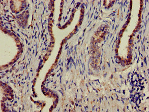 Immunohistochemistry of paraffin-embedded human prostate cancer using CSB-PA013458LA01HU at dilution of 1:100