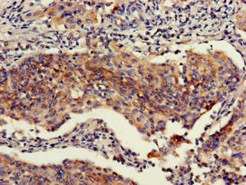 Immunohistochemistry of paraffin-embedded human cervical cancer using CSB-PA768776LA01HU at dilution of 1:100