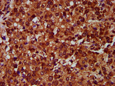 IHC image of CSB-PA007649LA01HU diluted at 1:400 and staining in paraffin-embedded human glioma performed on a Leica BondTM system. After dewaxing and hydration, antigen retrieval was mediated by high pressure in a citrate buffer (pH 6.0). Section was blocked with 10% normal goat serum 30min at RT. Then primary antibody (1% BSA) was incubated at 4°C overnight. The primary is detected by a biotinylated secondary antibody and visualized using an HRP conjugated SP system.