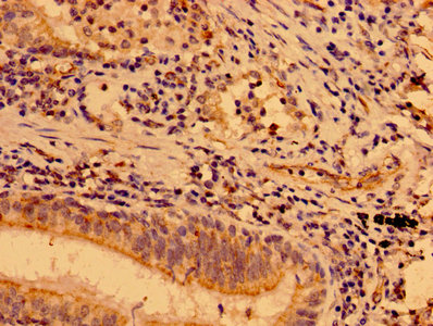 IHC image of CSB-PA013434LA01HU diluted at 1:400 and staining in paraffin-embedded human lung cancer performed on a Leica BondTM system. After dewaxing and hydration, antigen retrieval was mediated by high pressure in a citrate buffer (pH 6.0). Section was blocked with 10% normal goat serum 30min at RT. Then primary antibody (1% BSA) was incubated at 4°C overnight. The primary is detected by a biotinylated secondary antibody and visualized using an HRP conjugated SP system.