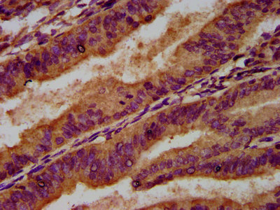 IHC image of CSB-PA013437LA01HU diluted at 1:500 and staining in paraffin-embedded human endometrial cancer performed on a Leica BondTM system. After dewaxing and hydration, antigen retrieval was mediated by high pressure in a citrate buffer (pH 6.0). Section was blocked with 10% normal goat serum 30min at RT. Then primary antibody (1% BSA) was incubated at 4°C overnight. The primary is detected by a biotinylated secondary antibody and visualized using an HRP conjugated SP system.