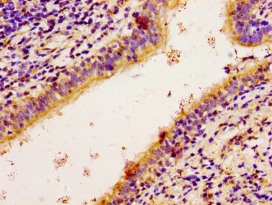 Immunohistochemistry of paraffin-embedded human lung cancer using CSB-PA618003LA01HU at dilution of 1:100