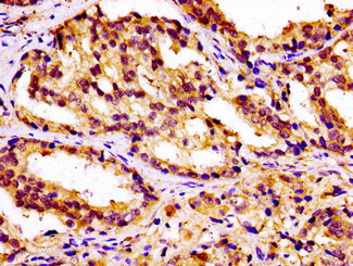 IHC image of CSB-PA822299LA01HU diluted at 1:100 and staining in paraffin-embedded human prostate cancer performed on a Leica BondTM system. After dewaxing and hydration, antigen retrieval was mediated by high pressure in a citrate buffer (pH 6.0). Section was blocked with 10% normal goat serum 30min at RT. Then primary antibody (1% BSA) was incubated at 4°C overnight. The primary is detected by a biotinylated secondary antibody and visualized using an HRP conjugated SP system.