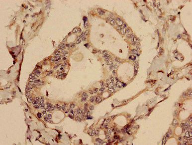 Immunohistochemistry analysis of human pancreatic cancer using CSB-PA850915LA01HU at dilution of 1:100