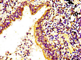 IHC image of CSB-PA891943LA01HU diluted at 1:400 and staining in paraffin-embedded human lung cancer performed on a Leica BondTM system. After dewaxing and hydration, antigen retrieval was mediated by high pressure in a citrate buffer (pH 6.0). Section was blocked with 10% normal goat serum 30min at RT. Then primary antibody (1% BSA) was incubated at 4°C overnight. The primary is detected by a biotinylated secondary antibody and visualized using an HRP conjugated SP system.