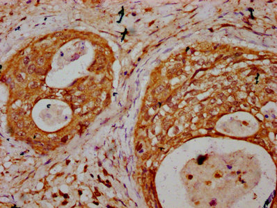 IHC image of CSB-PA892498LA01HU diluted at 1:400 and staining in paraffin-embedded human cervical cancer performed on a Leica BondTM system. After dewaxing and hydration, antigen retrieval was mediated by high pressure in a citrate buffer (pH 6.0). Section was blocked with 10% normal goat serum 30min at RT. Then primary antibody (1% BSA) was incubated at 4°C overnight. The primary is detected by a biotinylated secondary antibody and visualized using an HRP conjugated SP system.