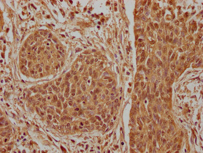 IHC image of CSB-PA002276LA01HU diluted at 1:100 and staining in paraffin-embedded human cervical cancer performed on a Leica BondTM system. After dewaxing and hydration, antigen retrieval was mediated by high pressure in a citrate buffer (pH 6.0). Section was blocked with 10% normal goat serum 30min at RT. Then primary antibody (1% BSA) was incubated at 4°C overnight. The primary is detected by a biotinylated secondary antibody and visualized using an HRP conjugated SP system.