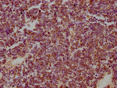 IHC image of CSB-PA010847LA01HU diluted at 1:300 and staining in paraffin-embedded human lung cancer performed on a Leica BondTM system. After dewaxing and hydration, antigen retrieval was mediated by high pressure in a citrate buffer (pH 6.0). Section was blocked with 10% normal goat serum 30min at RT. Then primary antibody (1% BSA) was incubated at 4°C overnight. The primary is detected by a biotinylated secondary antibody and visualized using an HRP conjugated SP system.