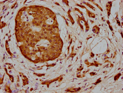 IHC image of CSB-PA013424LA01HU diluted at 1:400 and staining in paraffin-embedded human pancreatic cancer performed on a Leica BondTM system. After dewaxing and hydration, antigen retrieval was mediated by high pressure in a citrate buffer (pH 6.0). Section was blocked with 10% normal goat serum 30min at RT. Then primary antibody (1% BSA) was incubated at 4°C overnight. The primary is detected by a biotinylated secondary antibody and visualized using an HRP conjugated SP system.