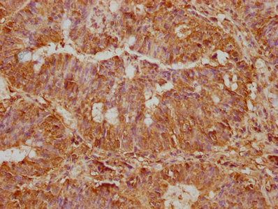 IHC image of CSB-PA022758LA01HU diluted at 1:500 and staining in paraffin-embedded human colon cancer performed on a Leica BondTM system. After dewaxing and hydration, antigen retrieval was mediated by high pressure in a citrate buffer (pH 6.0). Section was blocked with 10% normal goat serum 30min at RT. Then primary antibody (1% BSA) was incubated at 4°C overnight. The primary is detected by a biotinylated secondary antibody and visualized using an HRP conjugated SP system.