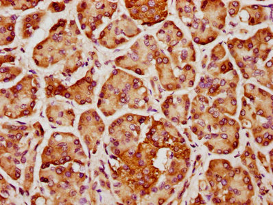 IHC image of CSB-PA744397LA01HU diluted at 1:400 and staining in paraffin-embedded human pancreatic cancer performed on a Leica BondTM system. After dewaxing and hydration, antigen retrieval was mediated by high pressure in a citrate buffer (pH 6.0). Section was blocked with 10% normal goat serum 30min at RT. Then primary antibody (1% BSA) was incubated at 4°C overnight. The primary is detected by a biotinylated secondary antibody and visualized using an HRP conjugated SP system.