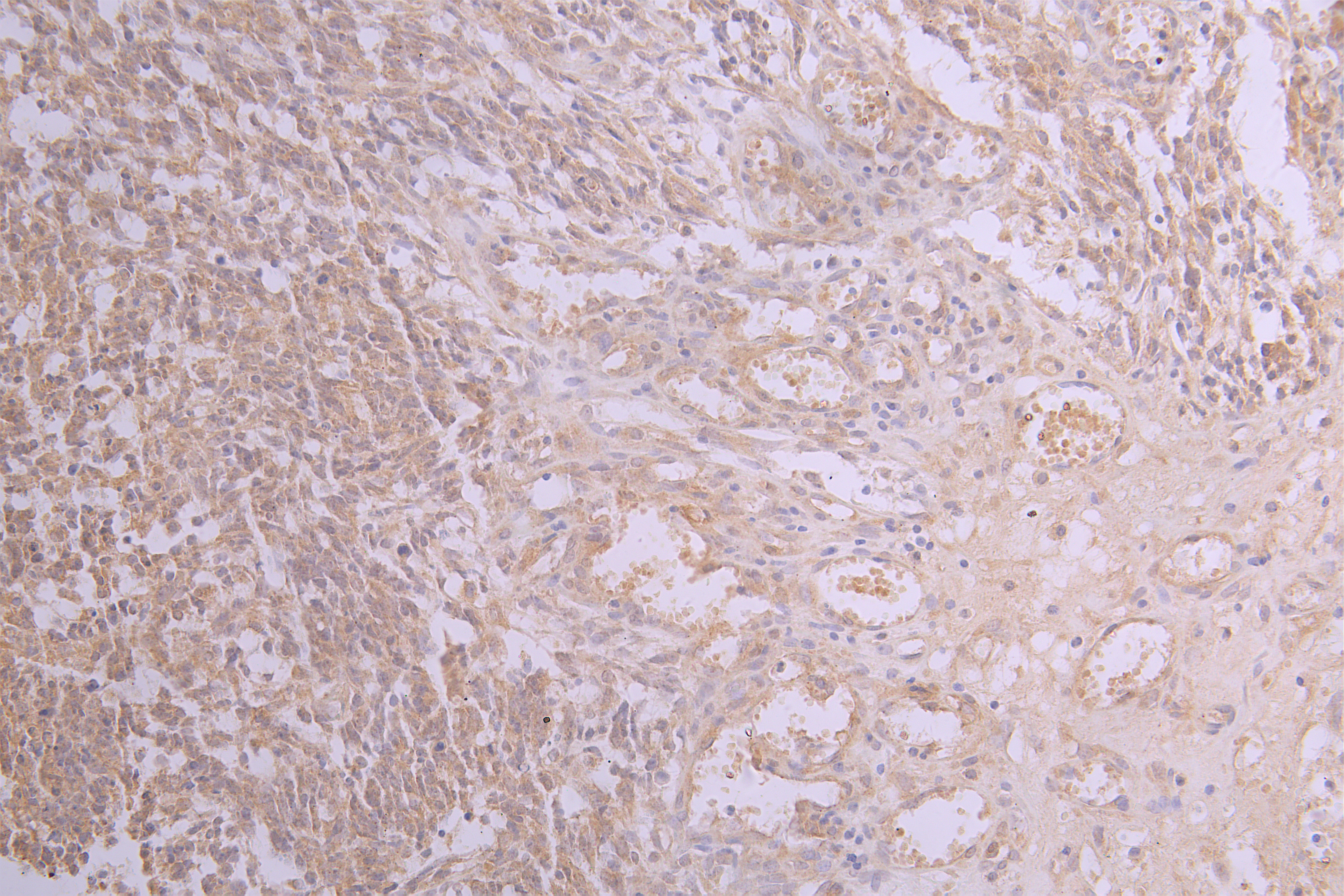 IHC image of CSB-RA001950MA2HU diluted at 1 : 50 and staining in paraffin-embedded human glioma cancer performed on a Leica BondTM system. After dewaxing and hydration, antigen retrieval was mediated by high pressure in a citrate buffer (pH 6.0). Section was blocked with 10% normal goat serum 30min at RT. Then primary antibody (1% BSA) was incubated at 4°C overnight. The primary is detected by a Goat anti-human polymer IgG labeled by HRP and visualized using 0.05% DAB.