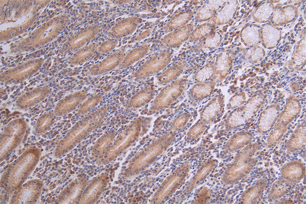 IHC image of CSB-RA003656A0HU diluted at 1:100 and staining in paraffin-embedded human breast cancer performed on a Leica BondTM system. After dewaxing and hydration, antigen retrieval was mediated by high pressure in a citrate buffer (pH 6.0). Section was blocked with 10% normal goat serum 30min at RT. Then primary antibody (1% BSA) was incubated at 4°C overnight. The primary is detected by a Goat anti-rabbit polymer IgG labeled by HRP and visualized using 0.18% DAB.