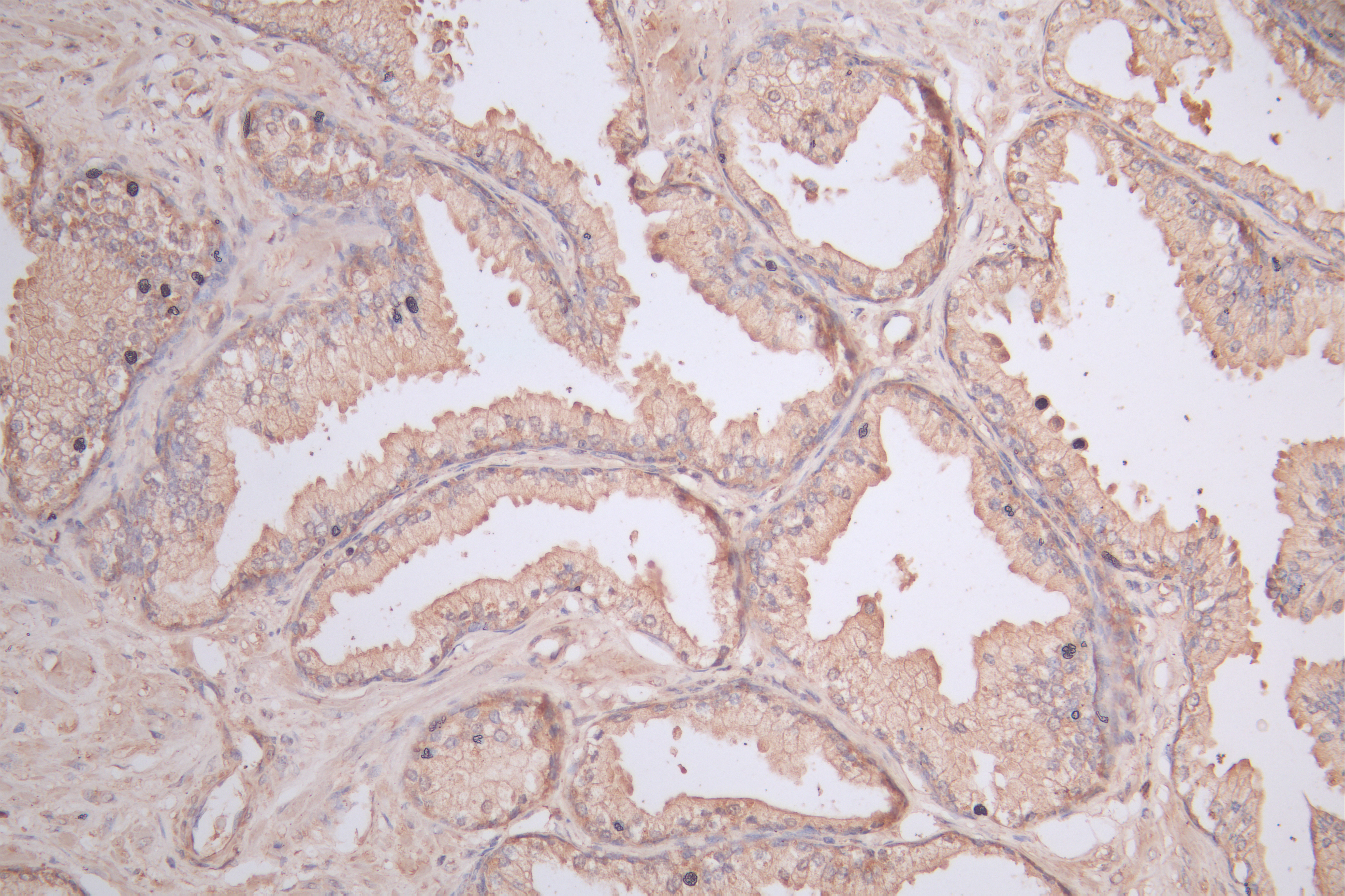 IHC image of CSB-RA005728MA1HU diluted at 1:50 and staining in paraffin-embedded human prostate cancer performed on a Leica BondTM system. After dewaxing and hydration, antigen retrieval was mediated by high pressure in a citrate buffer (pH 6.0). Section was blocked with 10% normal goat serum 30min at RT. Then primary antibody (1% BSA) was incubated at 4°C overnight. The primary is detected by a Goat anti-Mouse IgG labeled by HRP and visualized using 0.05% DAB.