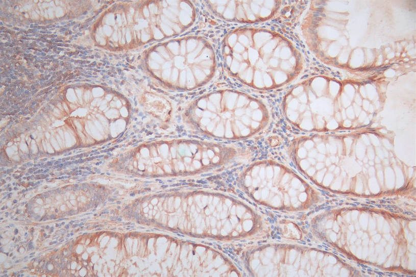 IHC image of CSB-RA006169MA1HU diluted at 1:100 and staining in paraffin-embedded human rectal cancer performed on a Leica BondTM system. After dewaxing and hydration, antigen retrieval was mediated by high pressure in a citrate buffer (pH 6.0). Section was blocked with 10% normal goat serum 30min at RT. Then primary antibody (1% BSA) was incubated at 4°C overnight. The primary is detected by a Goat anti-rabbit polymer IgG labeled by HRP and visualized using 0.05% DAB.