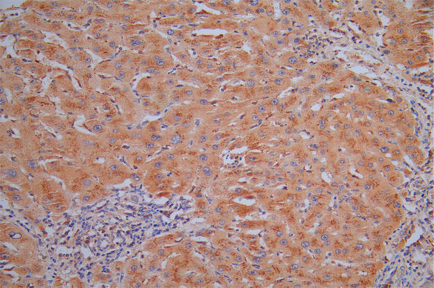 IHC image of CSB-RA006193MA1HU diluted at 1:30 and staining in paraffin-embedded human liver cancer performed on a Leica BondTM system. After dewaxing and hydration, antigen retrieval was mediated by high pressure in a citrate buffer (pH 6.0). Section was blocked with 10% normal goat serum 30min at RT. Then primary antibody (1% BSA) was incubated at 4°C overnight. The primary is detected by a Goat anti-Mouse IgG labeled by HRP and visualized using 0.05% DAB.