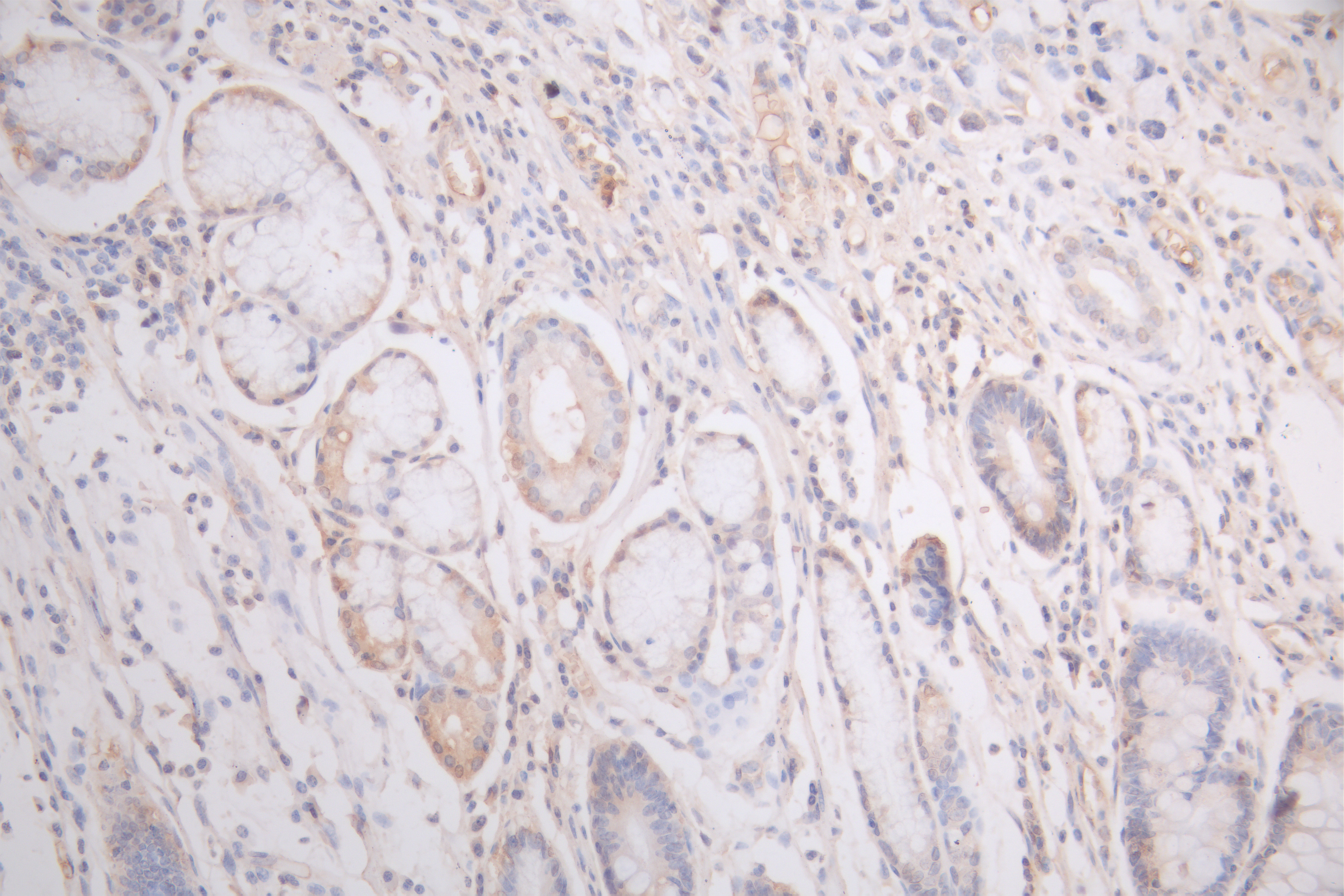 IHC image of CSB-RA008732MA1HU diluted at 1:200 and staining in paraffin-embedded human gastric cancer performed on a Leica BondTM system. After dewaxing and hydration, antigen retrieval was mediated by high pressure in a citrate buffer (pH 6.0). Section was blocked with 10% normal goat serum 30min at RT. Then primary antibody (1% BSA) was incubated at 4°C overnight. The primary is detected by a Goat anti-human polymer IgG labeled by HRP and visualized using 0.05% DAB.