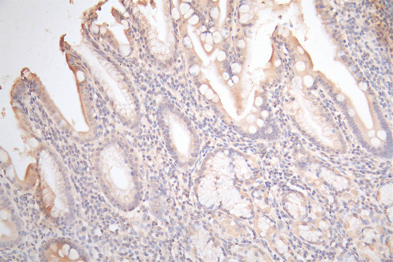 IHC image of CSB-RA009452MA1HU diluted at 1:100 and staining in paraffin-embedded human gastric cancer performed on a Leica BondTM system. After dewaxing and hydration, antigen retrieval was mediated by high pressure in a citrate buffer (pH 6.0). Section was blocked with 10% normal goat serum 30min at RT. Then primary antibody (1% BSA) was incubated at 4°C overnight. The primary is detected by a Goat anti-Mouse IgG labeled by HRP and visualized using 0.05% DAB.