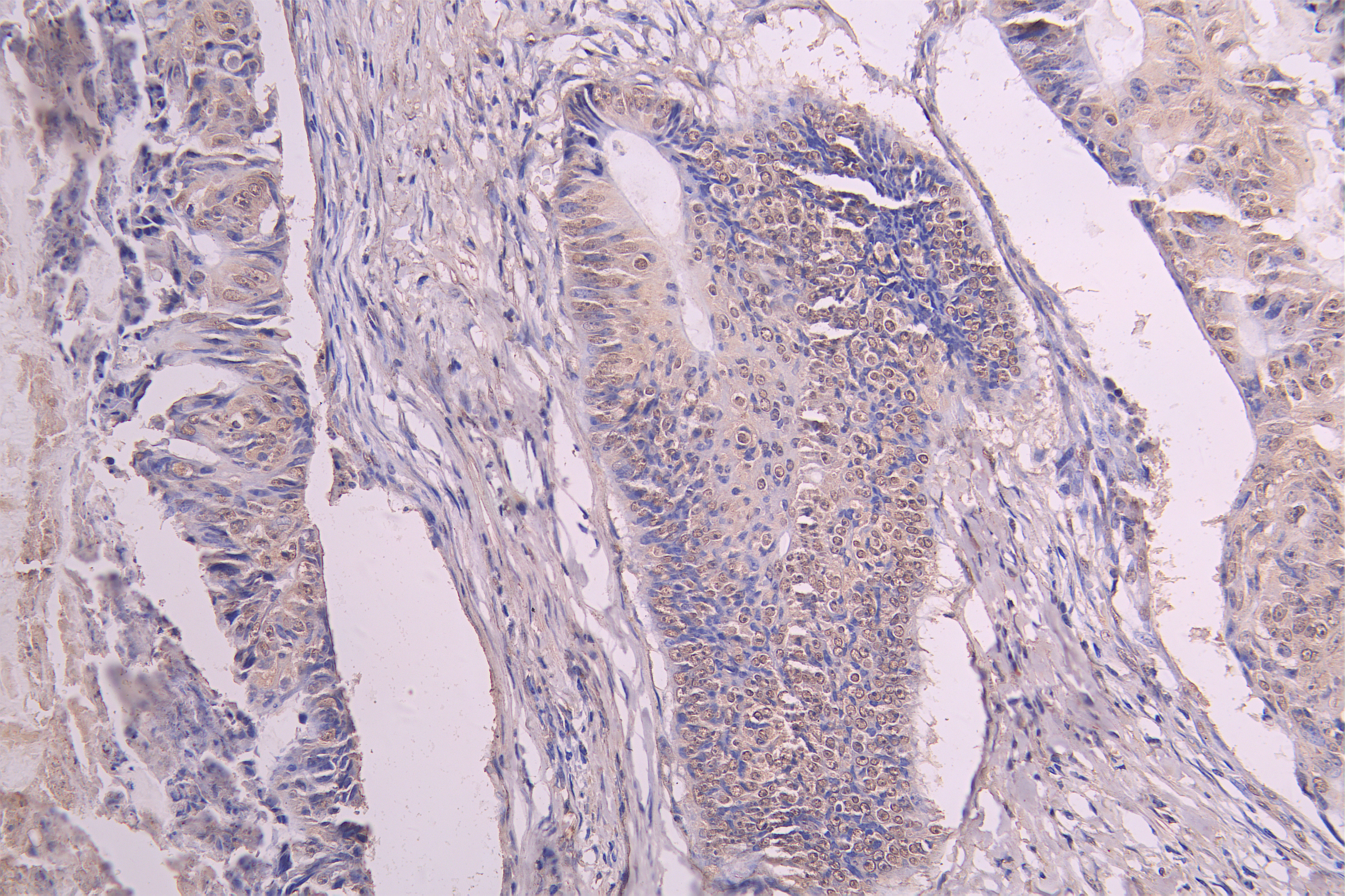 IHC image of CSB-RA009892MA1HU diluted at 1 : 100 and staining in paraffin-embedded human colon cancer performed on a Leica BondTM system. After dewaxing and hydration, antigen retrieval was mediated by high pressure in a citrate buffer (pH 6.0). Section was blocked with 10% normal goat serum 30min at RT. Then primary antibody (1% BSA) was incubated at 4°C overnight. The primary is detected by a Goat anti-human polymer IgG labeled by HRP and visualized using 0.05% DAB.