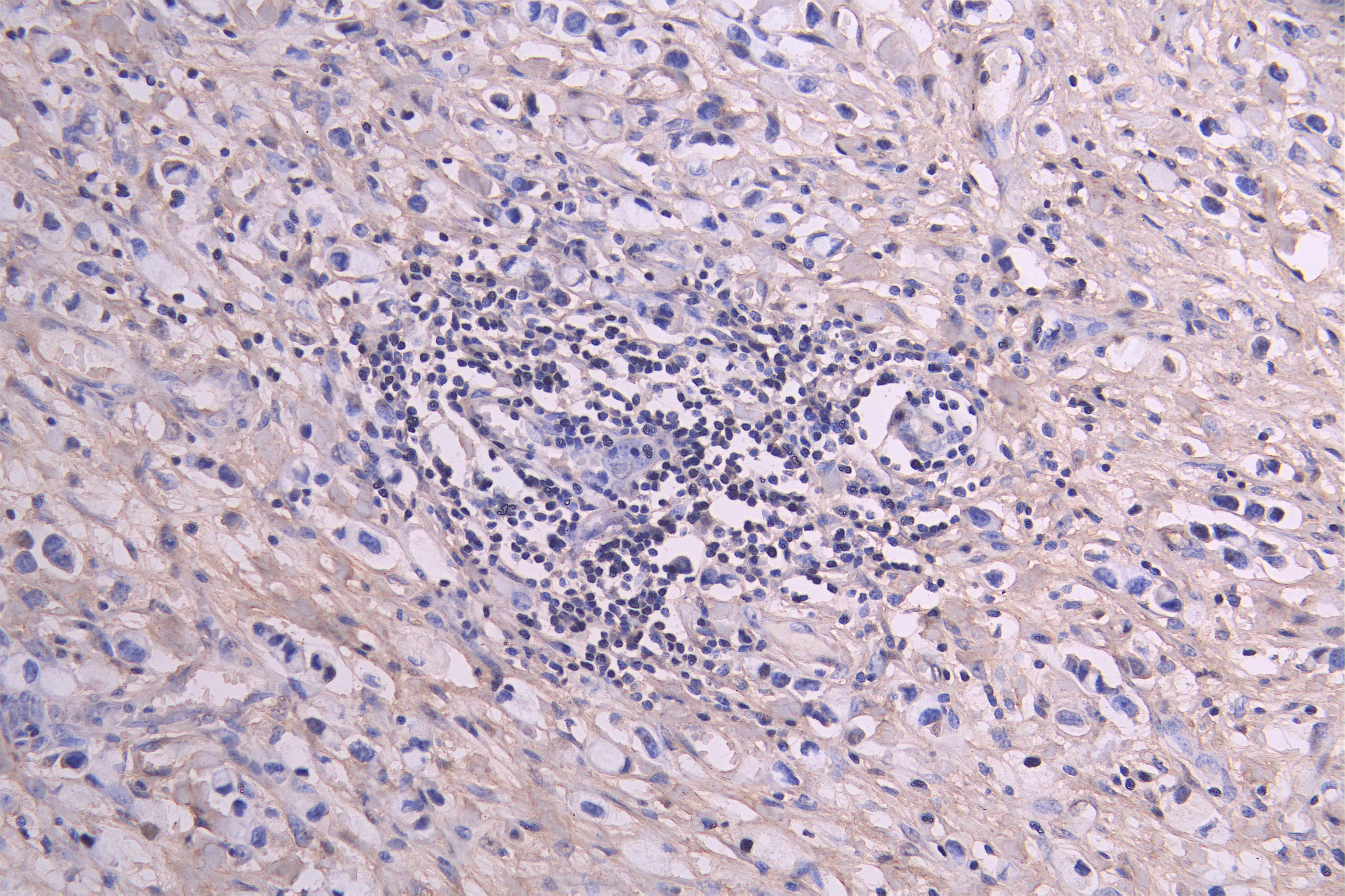 IHC image of CSB-RA009892MA1HU diluted at 1 : 100 and staining in paraffin-embedded human gastric cancer performed on a Leica BondTM system. After dewaxing and hydration, antigen retrieval was mediated by high pressure in a citrate buffer (pH 6.0). Section was blocked with 10% normal goat serum 30min at RT. Then primary antibody (1% BSA) was incubated at 4°C overnight. The primary is detected by a Goat anti-human polymer IgG labeled by HRP and visualized using 0.05% DAB.