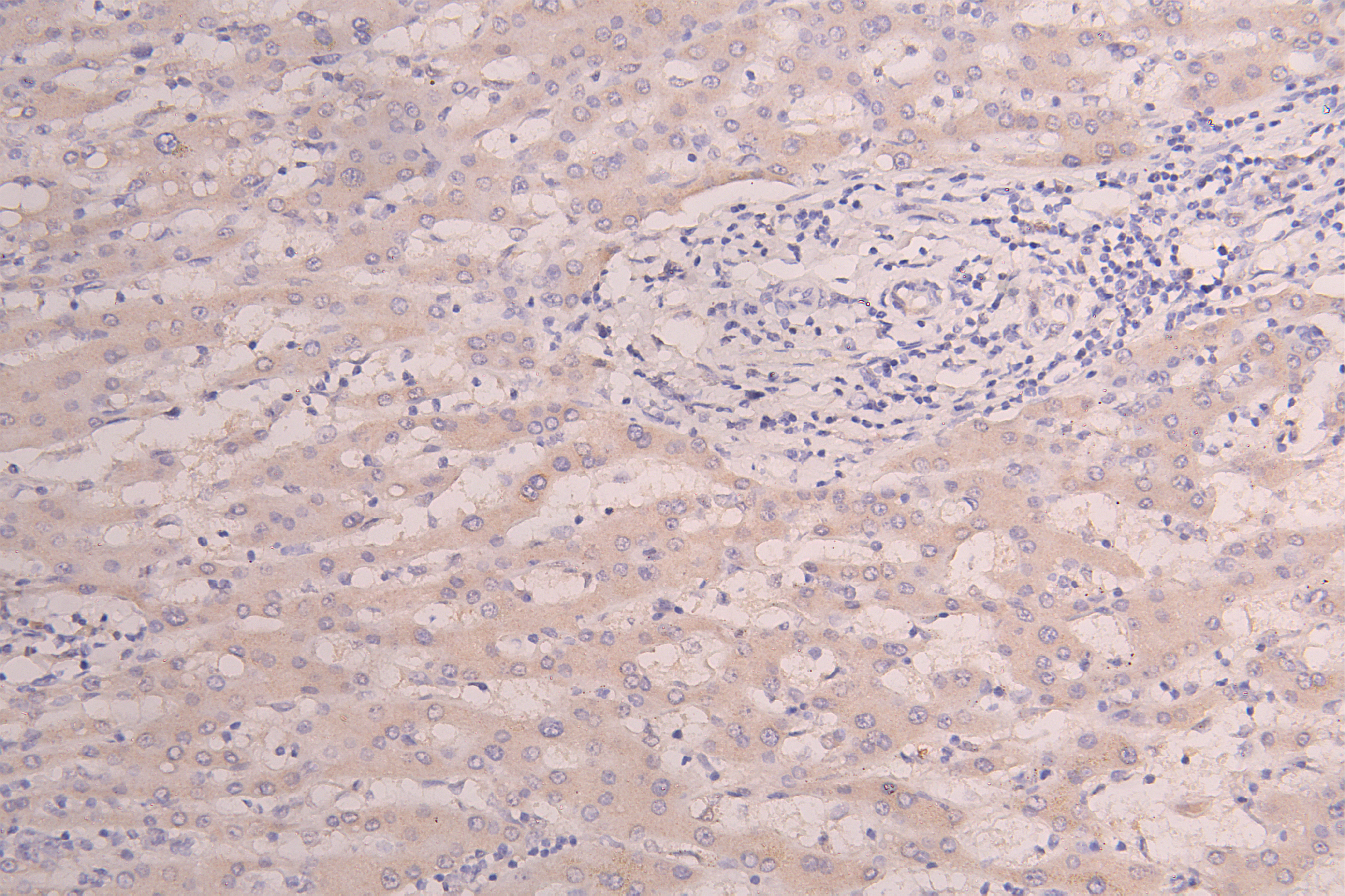 IHC image of CSB-RA010327MA1HU diluted at 1:100 and staining in paraffin-embedded human Liver cancer performed on a Leica BondTM system. After dewaxing and hydration, antigen retrieval was mediated by high pressure in a citrate buffer (pH 6.0). Section was blocked with 10% normal goat serum 30min at RT. Then primary antibody (1% BSA) was incubated at 4°C overnight. The primary is detected by a Goat anti-Human IgG labeled by HRP and visualized using 0.05% DAB.