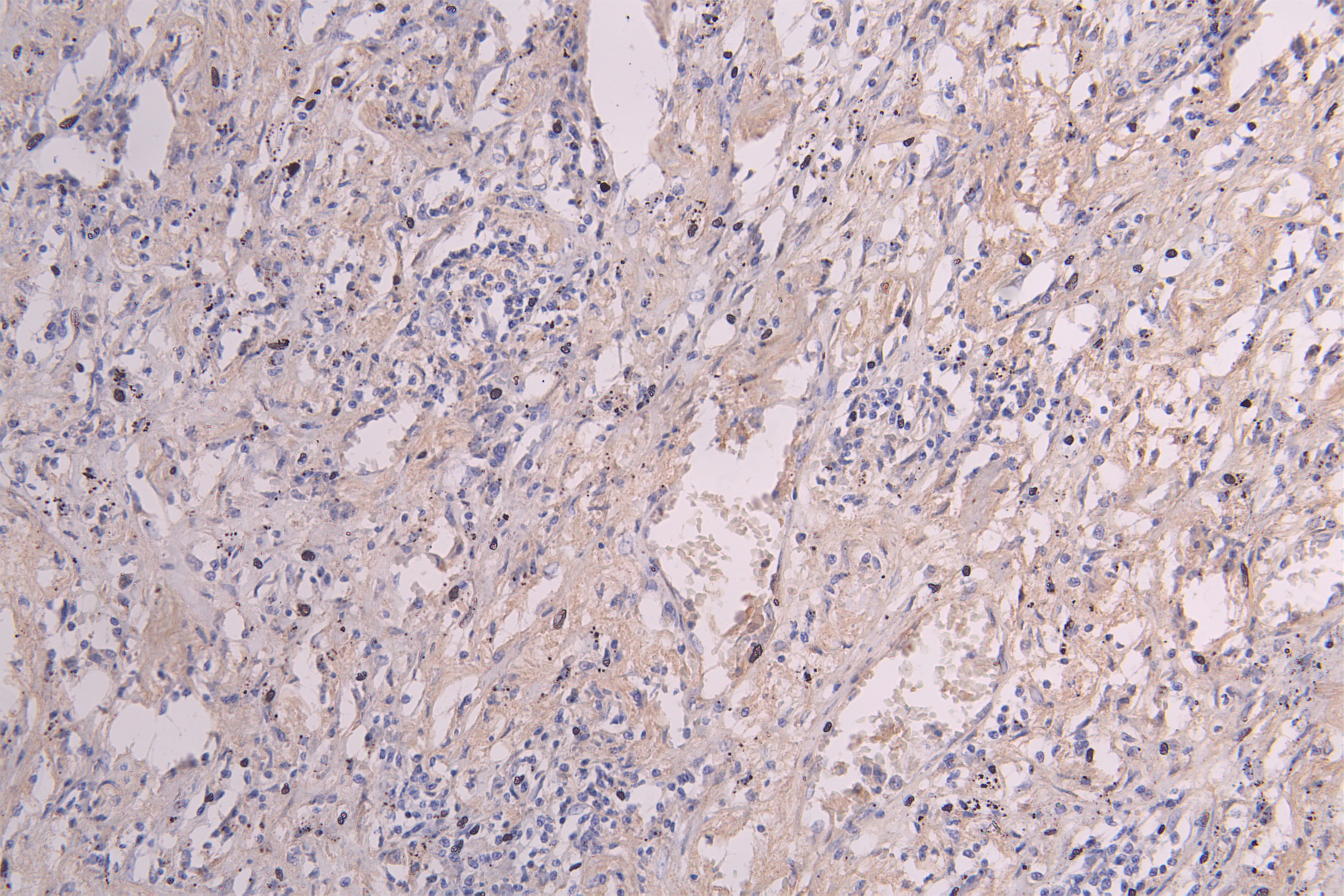 IHC image of CSB-RA011048MA1HU diluted at 1:300 and staining in paraffin-embedded human lung cancer performed on a Leica BondTM system. After dewaxing and hydration, antigen retrieval was mediated by high pressure in a citrate buffer (pH 6.0). Section was blocked with 10% normal goat serum 30min at RT. Then primary antibody (1% BSA) was incubated at 4°C overnight. The primary is detected by a Goat anti-Human IgG labeled by HRP and visualized using 0.05% DAB.