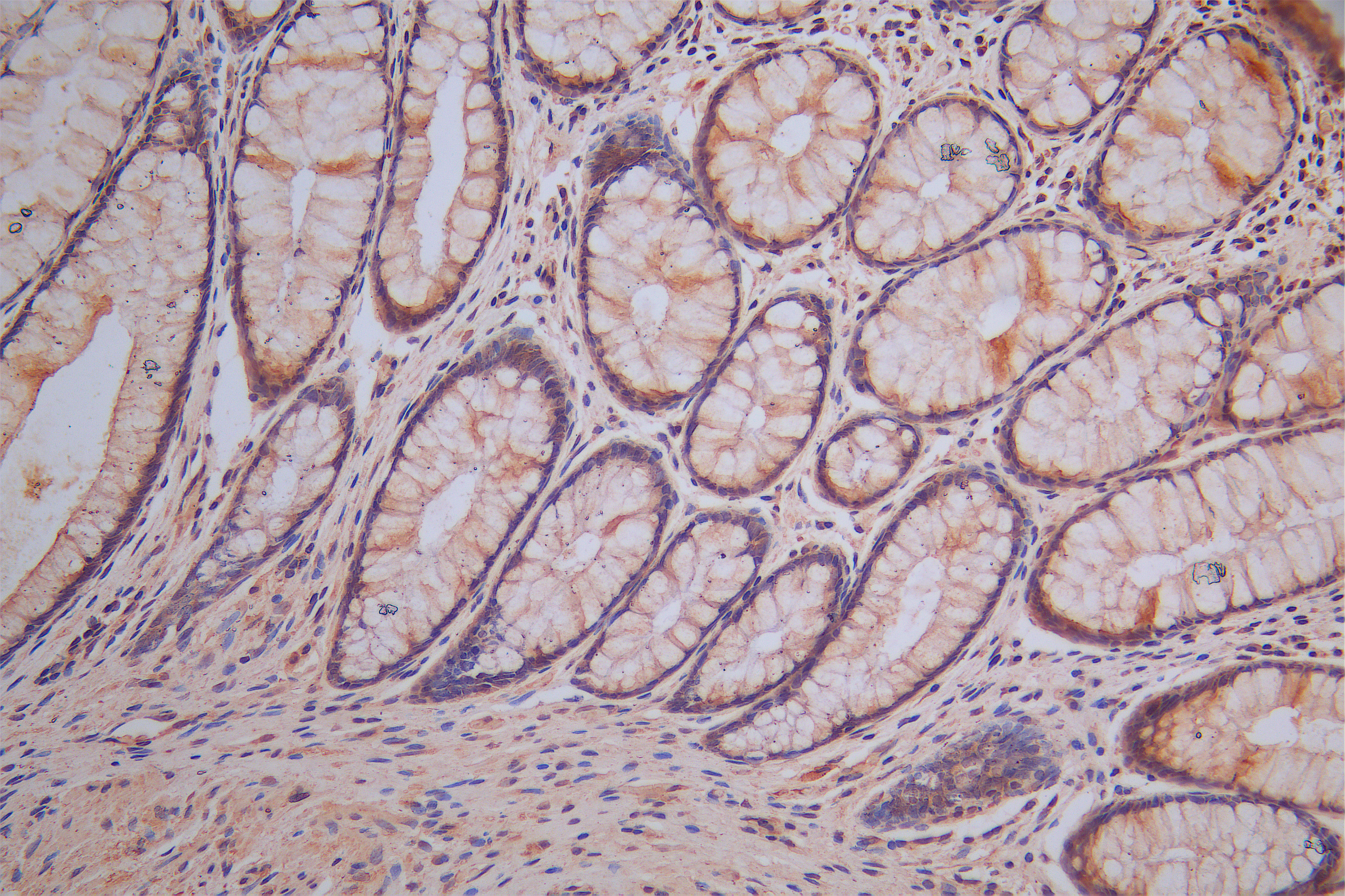 IHC image of CSB-RA023024MA1HU diluted at 1:200 and staining in paraffin-embedded human colorectal cancer performed on a Leica BondTM system. After dewaxing and hydration, antigen retrieval was mediated by high pressure in a citrate buffer (pH 6.0). Section was blocked with 10% normal goat serum 30min at RT. Then primary antibody (1% BSA) was incubated at 4°C overnight. The primary is detected by a Goat anti-Mouse IgG labeled by HRP and visualized using 0.05% DAB.