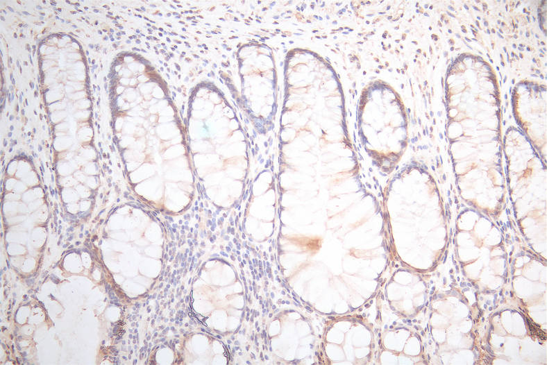 IHC image of CSB-RA025440MA1HU diluted at 1:300 and staining in paraffin-embedded human colorectal cancer performed on a Leica BondTM system. After dewaxing and hydration, antigen retrieval was mediated by high pressure in a citrate buffer (pH 6.0). Section was blocked with 10% normal goat serum 30min at RT. Then primary antibody (1% BSA) was incubated at 4°C overnight. The primary is detected by a Goat anti-Mouse IgG labeled by HRP and visualized using 0.05% DAB.