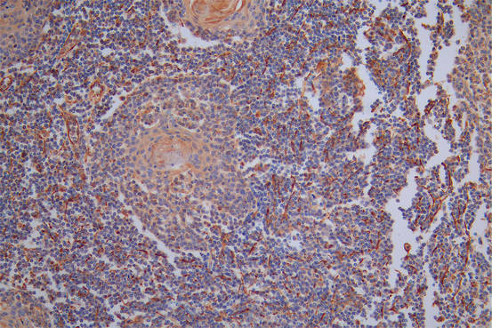 IHC image of CSB-RA025857MA1HU diluted at 1:40 and staining in paraffin-embedded human tonsil tissue performed on a Leica BondTM system. After dewaxing and hydration, antigen retrieval was mediated by high pressure in a citrate buffer (pH 6.0). Section was blocked with 10% normal goat serum 30min at RT. Then primary antibody (1% BSA) was incubated at 4°C overnight. The primary is detected by a Goat anti-Rabbit IgG labeled by HRP and visualized using 0.05% DAB.